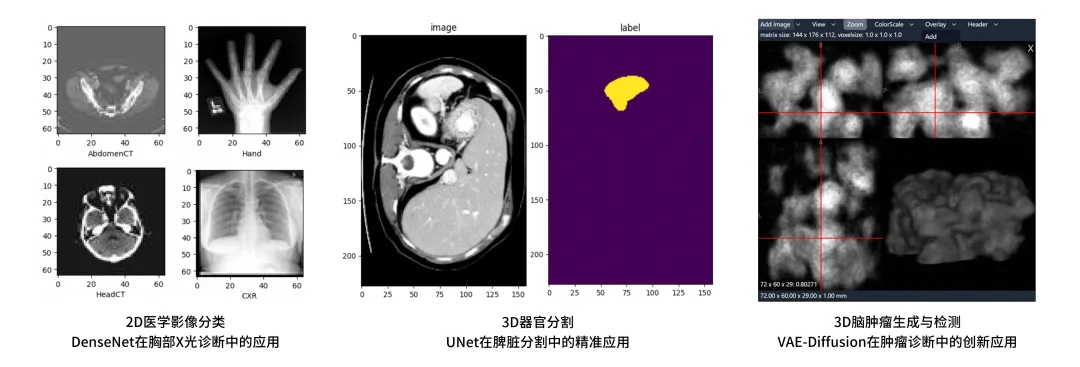 摩尔线程开源MUSA加速版MONAI 1.5.0，国产全功能GPU赋能AI医学影像